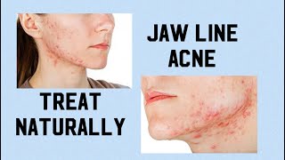 Hormonal acne jawline acne natural treatment of acne [upl. by Ayetal]