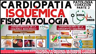 CARDIOPATÍA ISQUÉMICA FISIOPATOLOGÍA  GuiaMed [upl. by Eiramanig]