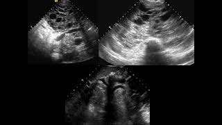 Chest FRCR2b CASES [upl. by Leschen]