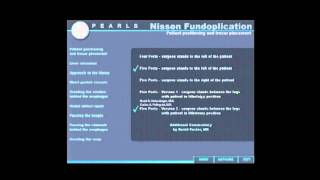 SAGES Pearls Session Laparoscopic Nissen Fundoplication introduction [upl. by Valonia920]