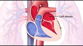 Mitral Valve Regurgitation [upl. by Naashar]