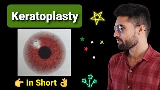 Keratoplasty lecture in opthalmology [upl. by Oiligriv]