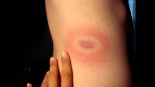 Erythema Chronicum Migrans from Ixodes Tick Bite Lyme Disease Borrelia [upl. by Arrotal]