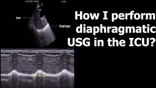 How I perform diaphragmatic USG in the ICU [upl. by Brass936]