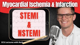 Myocardial Ischemia amp Infarction on EKG  STEMI amp NSTEMI ECG [upl. by Meek]