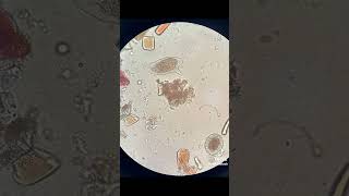 Schistosoma and Ascaris eggs in stool [upl. by Lehar]