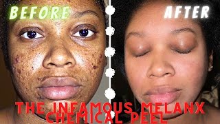 TRUTH ABOUT PORE STAR 850 CHEMICAL PEEL [upl. by Seaton]