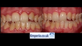 What is Periodontal Maintenance [upl. by Nelloc958]