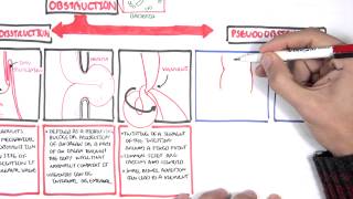 Bowel Obstruction  Causes and Pathophysiology [upl. by Sauncho]