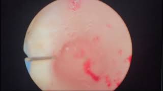 Septal Resection in complete uterine septum [upl. by Nirag68]