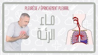 تدويزة  الماء فالرئة TEDWIZA  Pleurésie  épanchement pleural [upl. by Cathee]