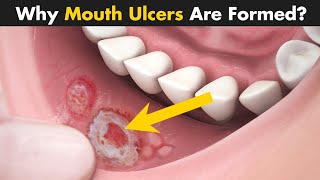 Mouth Ulcers  Mouth Ulcers Symptoms Causes And Treatment  Demystifying science [upl. by Stucker]