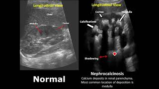 Kidney Ureter and Bladder KUB Ultrasound Normal Vs Abnormal Image Appearances Comparison [upl. by Kile]