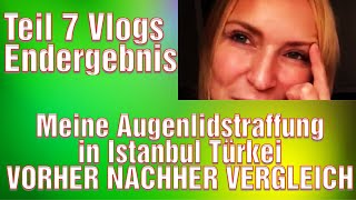 Augenlidstraffung Türkei Erfahrung Lidstraffung Vorhher Nachher Bilder Medical Exclusive Istanbul [upl. by Minoru]