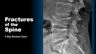 Fractures of the Spine XRay Cases radiology spine trauma doctor [upl. by Myrtice]