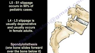 SpondylolysisSpondylolisthesisSpondylitisampSpondylosisEverythingYou Need To KnowDrNabil Ebraheim [upl. by Tnomyar]