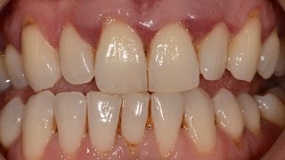 Treatment of Advanced Periodontal Gum Disease with Non surgical and Surgical Periodontal Therapy [upl. by Pip]