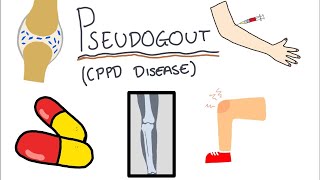 Pseudogout Calcium Pyrophosphate Disease  Simple and easy to understand [upl. by Gaultiero]