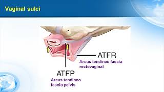 Pubourethral and urethropelvic ligaments plication rationale amp tecnique [upl. by Hermes]