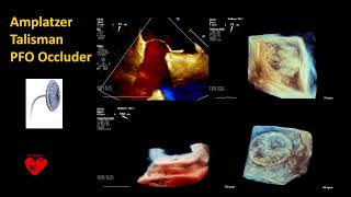 AMPLATZER PFO Occluder [upl. by Renie]