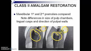 Oper Dent 1 Amalgam Restoration part 3 [upl. by Lotsirb]