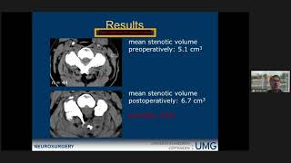 Unilateral hemilaminectomy for bilateral decompression in cervical spondylotic myelopathy [upl. by Shear]