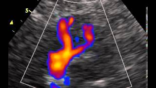 intracranial vertebral arteries and basilar artery transcranial color Doppler [upl. by Yornoc112]