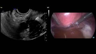 Transvaginal ultrasound features of normal uterosacral ligaments [upl. by Eluj731]