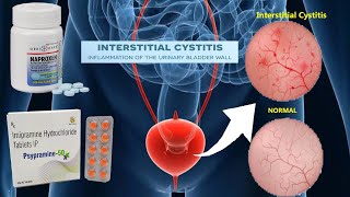 Interstitial Cystitis Treatment  Best Medicine Use to Treat Interstitial Cystitis [upl. by Levan]