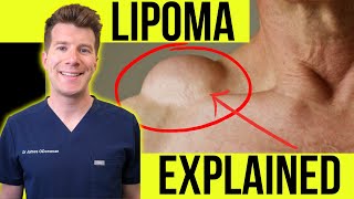 Doctor explains LIPOMA  Symptoms clinical photos and treatment [upl. by Nosna]