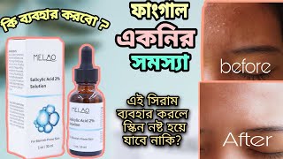 Melao Salicylic acid review  এই একটি সিরামে আপনার স্কিনের ব্রন দূর করবে😱 [upl. by Dielle579]