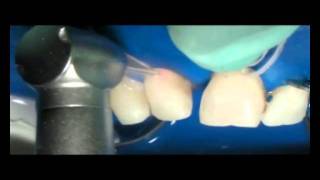 Doctor Smile Dental Laser Erbium Yag Etching treatment [upl. by Zennie375]