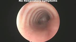 Effects of Posterior Tracheopexy for treatment of tracheomalacia [upl. by Arat]