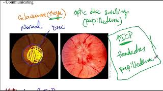 USMLE ACE Video 199 Overview of Hydrocephalus Types and Associated Conditions [upl. by Truk924]