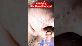 Crazy BLACKHEAD REMOVAL  Blackhead Extraction shorts [upl. by Winslow]