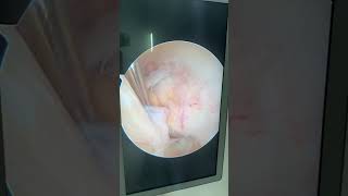 ACL ganglion cystkeyhole surgery arthroscopic decompression kneearthroscopy acl ganglioncyst [upl. by Nagaek]