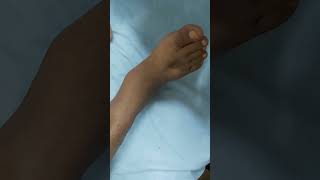 Pitting edema  DCLD patient clinicalexamination hospital doctor [upl. by Tenahs]