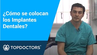 ¿Cómo se colocan los Implantes Dentales [upl. by Ahsinek]