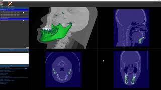 Deep learning based CT Segmentation mandible Demo [upl. by Hakym539]