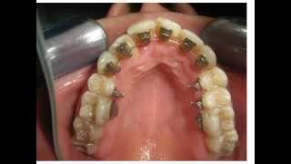 lingual Orthodontic Treatment Orthodontist [upl. by Barry]