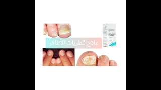 علاج فطريات الأظافر [upl. by Wallache741]