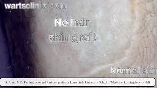 Skin graft and genital warts  not natural look [upl. by Inail]