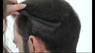 Hattingen Hair Transplantation 4000 FUs Follicular Unit Transplantation [upl. by Richmound739]