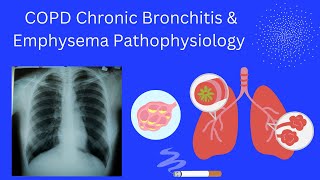 COPD Chronic Bronchitis amp Emphysema Pathophysiology [upl. by Artimas754]