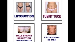 Liposuction Tummy Tuck  A TV interview [upl. by Ymmac]