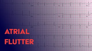 Atrial Flutter  EKG ECG Interpretation [upl. by Ahseiuqal]