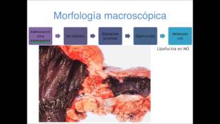 Adenocarcinoma de colon  Patología II [upl. by Lauri]