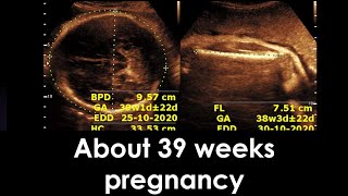 Practical ultrasound case  About 39 weeks pregnancy [upl. by Carling]