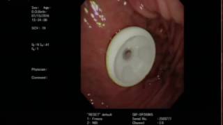 內視鏡胃造口術 Endoscopic Gastrostomy with Ultrathin Endoscope [upl. by Anrahc]