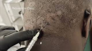 Intralesional Steroid Injections for Acne Keloidalis Nuchae rejuvenceclinic91 [upl. by Urban]